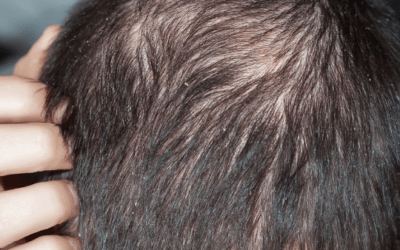 Soluzioni Personalizzate per la Salute dei Capelli: Il Ruolo della Galenica Tricologica