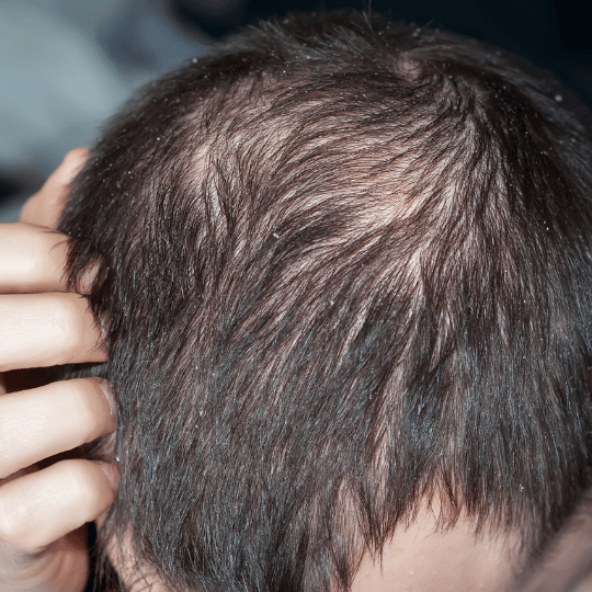 Soluzioni Personalizzate per la Salute dei Capelli: Il Ruolo della Galenica Tricologica